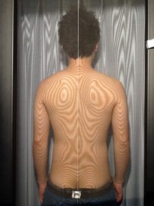 モアレ測定による背面の姿勢分析