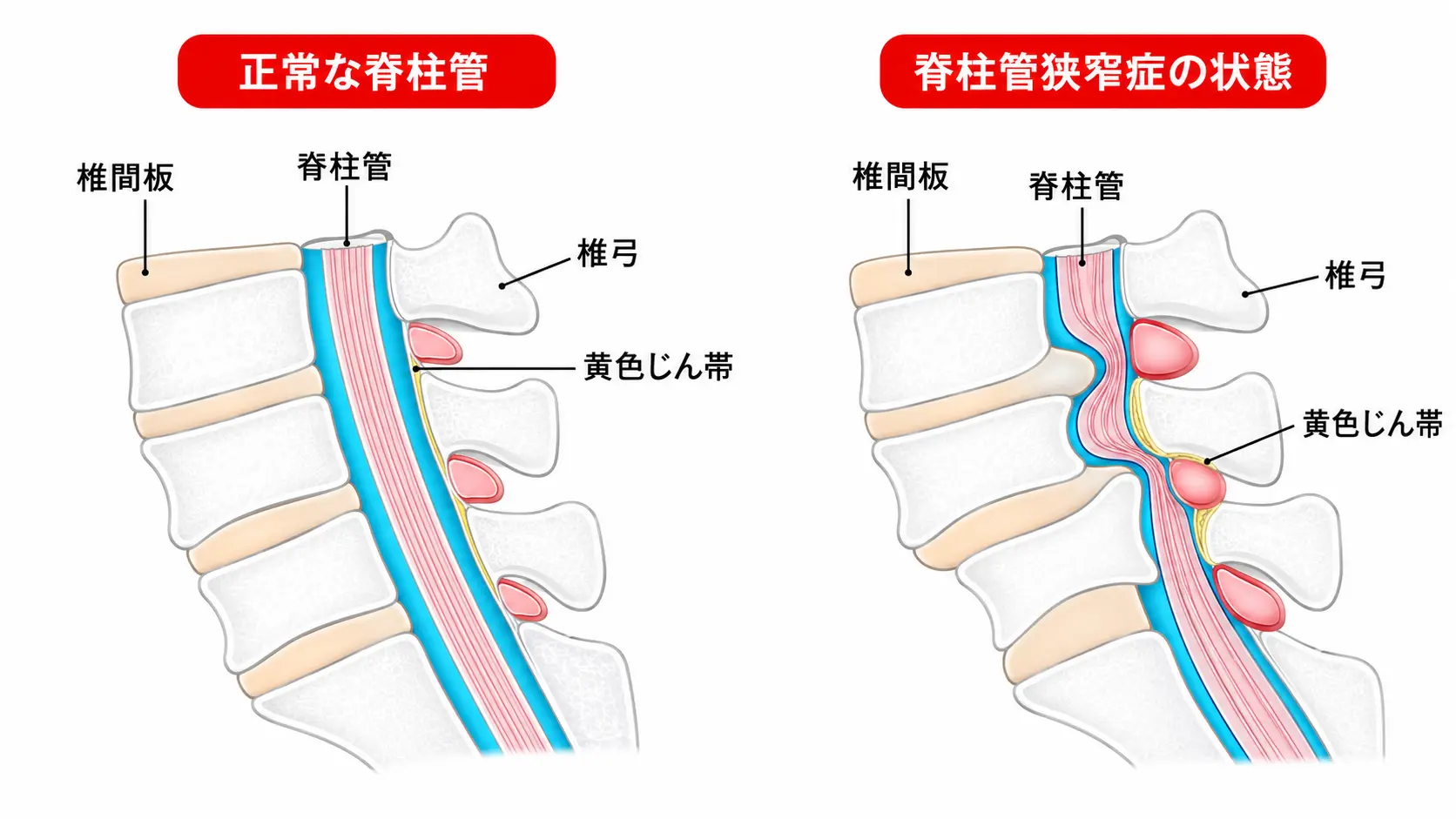 八王子で脊柱管狭窄症の歩くと痛い症状を説明する画像 多摩鍼灸整骨院 京王八王子院