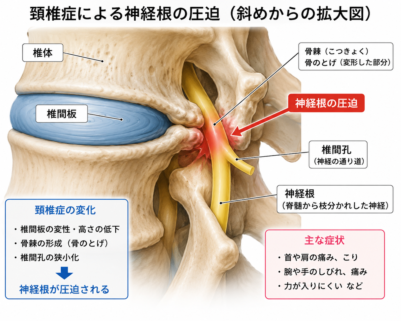 頚椎症による神経根の圧迫を示した説明画像