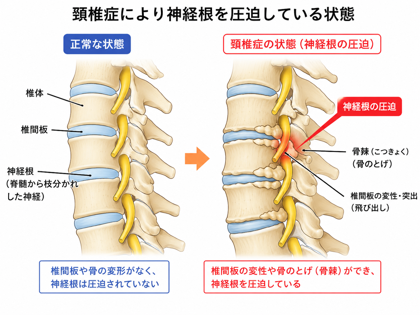 頚椎症により神経根を圧迫している状態を示した比較画像