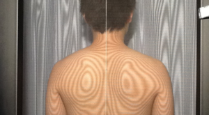 モアレ検査による背中の歪み・姿勢バランス評価｜八王子みなみ野の整骨院