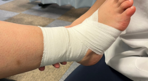 足首の捻挫に対するテーピング固定｜八王子みなみ野の整骨院