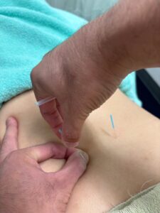 日野市　高幡不動駅　多摩整骨院　高幡不動院　腰部の鍼施術