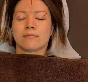 高倉本院の花粉症鍼治療イメージ