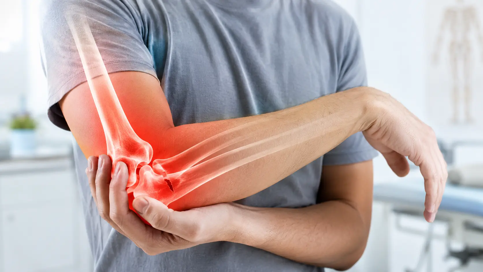 モンテギア骨折による肘や前腕のケガをイメージした、肘関節と前腕骨の損傷部位を示す医療イメージ