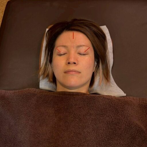 眉間や目の周囲、鼻の両わきに鍼を打ち、鼻づまりや目のかゆみを和らげる花粉症ケアの施術中の様子。迎香や印堂などのツボを丁寧に刺激しています。